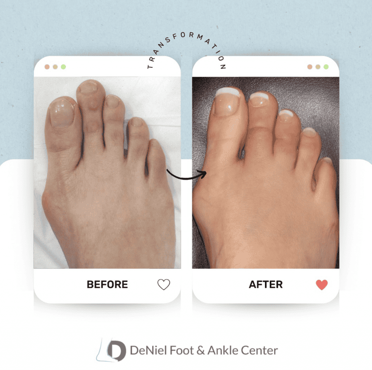 Foot before and after cosmetic toe shortening at DeNiel Foot and Ankle Center