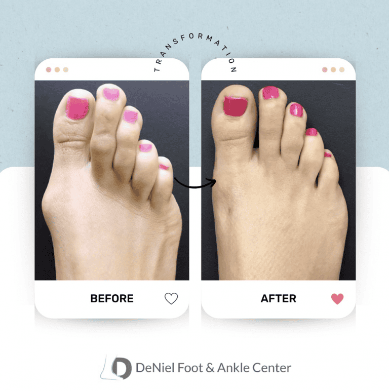 Before and after hammertoe correction at DeNiel Foot and Ankle Center in Houston
