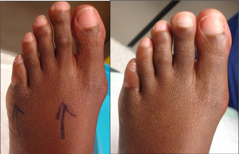 Comparison of toe length before and after toe shortening surgery