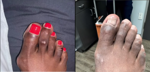 Transformative - A minimally invasive bunion surgery offers swift relief and minimal downtime.