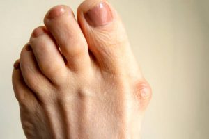 the bunion—a visible reminder of foot discomfort and the need for effective treatment.