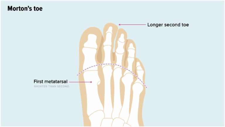 Diagram showing Morton's toe, with a longer second toe and a shorter first metatarsal