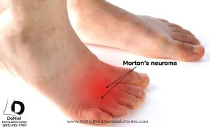 Mortons Neuroma