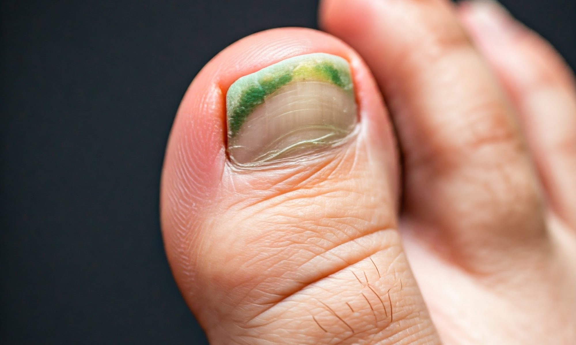 onychomycosis green toenail fungus