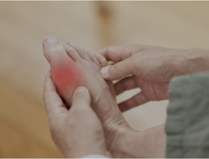 A visibly swollen and red big toe joint, with inflammation extending to the surrounding area.