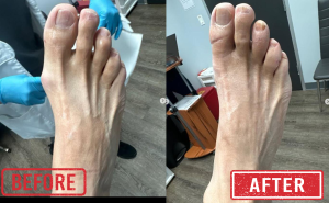 celebrities with bunions, celebrities with bunions on feet, famous athletes with bunions, worst celebrity bunions, bunion treatment, bunionectomy, bunion surgery Houston, DeNiel Foot and Ankle Center, Dr. Ejodamen Shobowale, DPM.