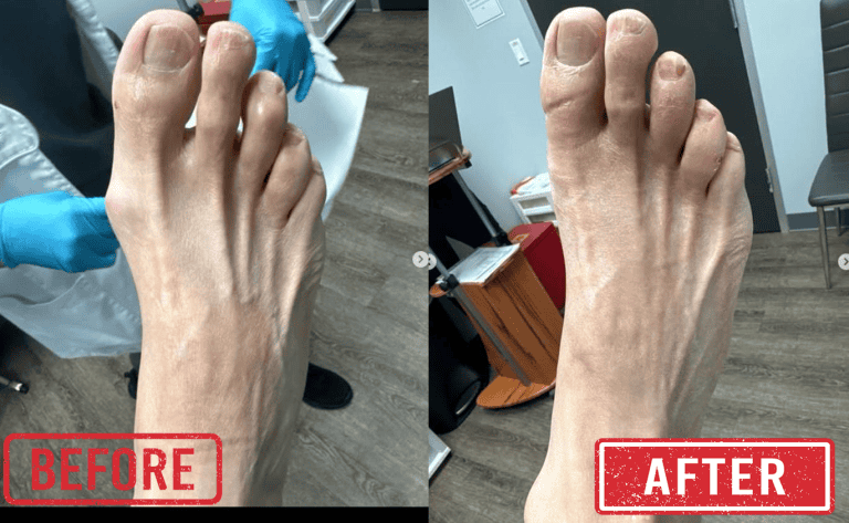Foot bunion correction before and after treatment at DeNiel Foot and Ankle Center