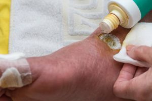 That fizz might look like it’s helping, but hydrogen peroxide can actually damage healthy tissue and slow healing—especially in diabetic wounds. 