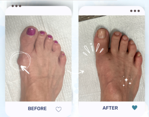 minimally invasive bunion surgery at DeNiel Foot & Ankle Center