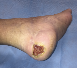 A diabetic foot wound is an open sore that often develops unnoticed due to nerve damage and can lead to serious complications if left untreated.