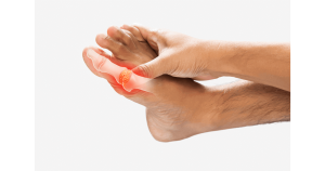 A foot affected by uric acid crystals shows inflammation, swelling, and intense pain, often centered around the big toe joint where sharp crystals have accumulated.