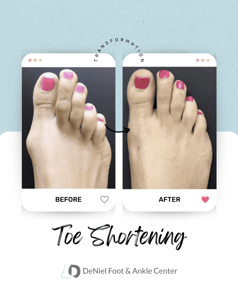 Before and after toe shortening treatment by Dr. Ejodamen B Shobowale, DPM in Houston
