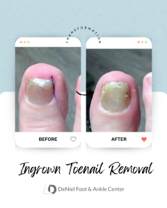 Ingrown Toenail Removal - Before & After