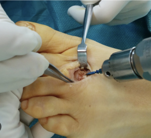 By adjusting bone position, osteotomy enhances joint alignment and overall foot mechanics.