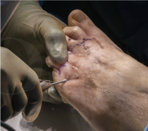 With osteotomy, patients can regain a more natural gait and pain-free movement.