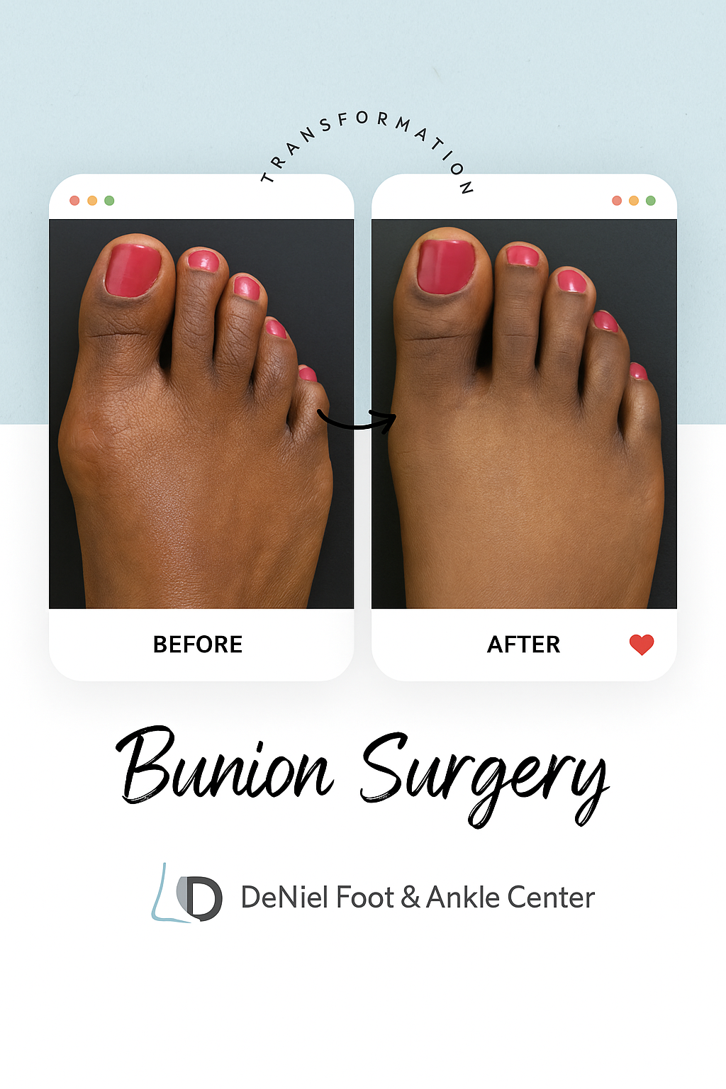 Bunion Surgery Before & After