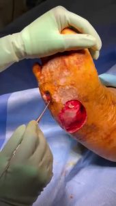 Deep Diabetic Wound