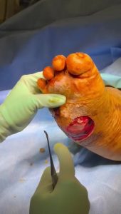 Deep wounds form when pressure, poor circulation, and neuropathy combine