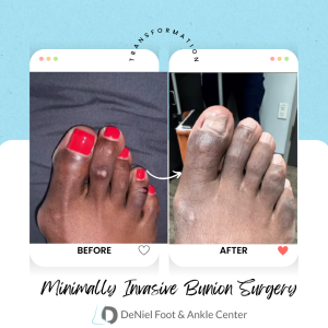 Minimally Invasive Bunion Surgery
