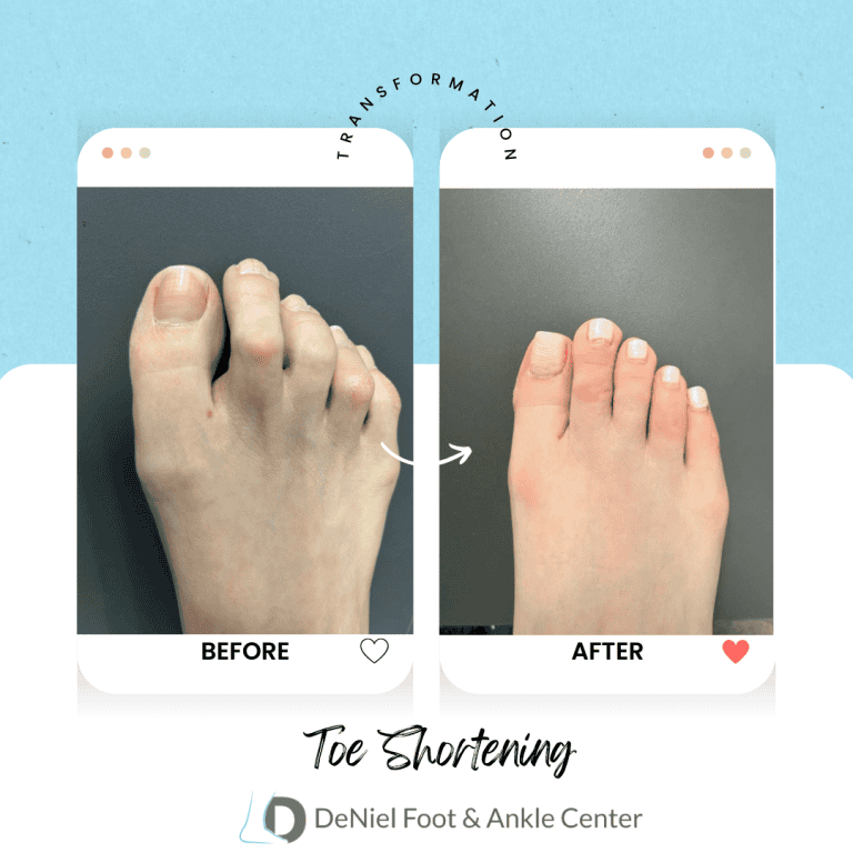 Before and after toe shortening surgery at DeNiel Foot and Ankle Center, Houston