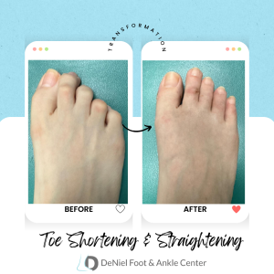 Toe Shortening & Straightening