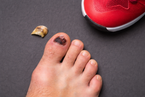 Close-up of a big toe with a fallen-off toenail, showing a bruised nail bed with dried blood, and the detached toenail placed beside the foot.