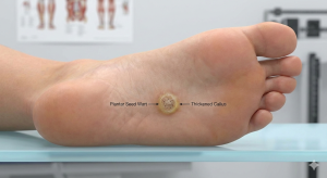 A visualization of a plantar seed wart on the sole of a human foot.