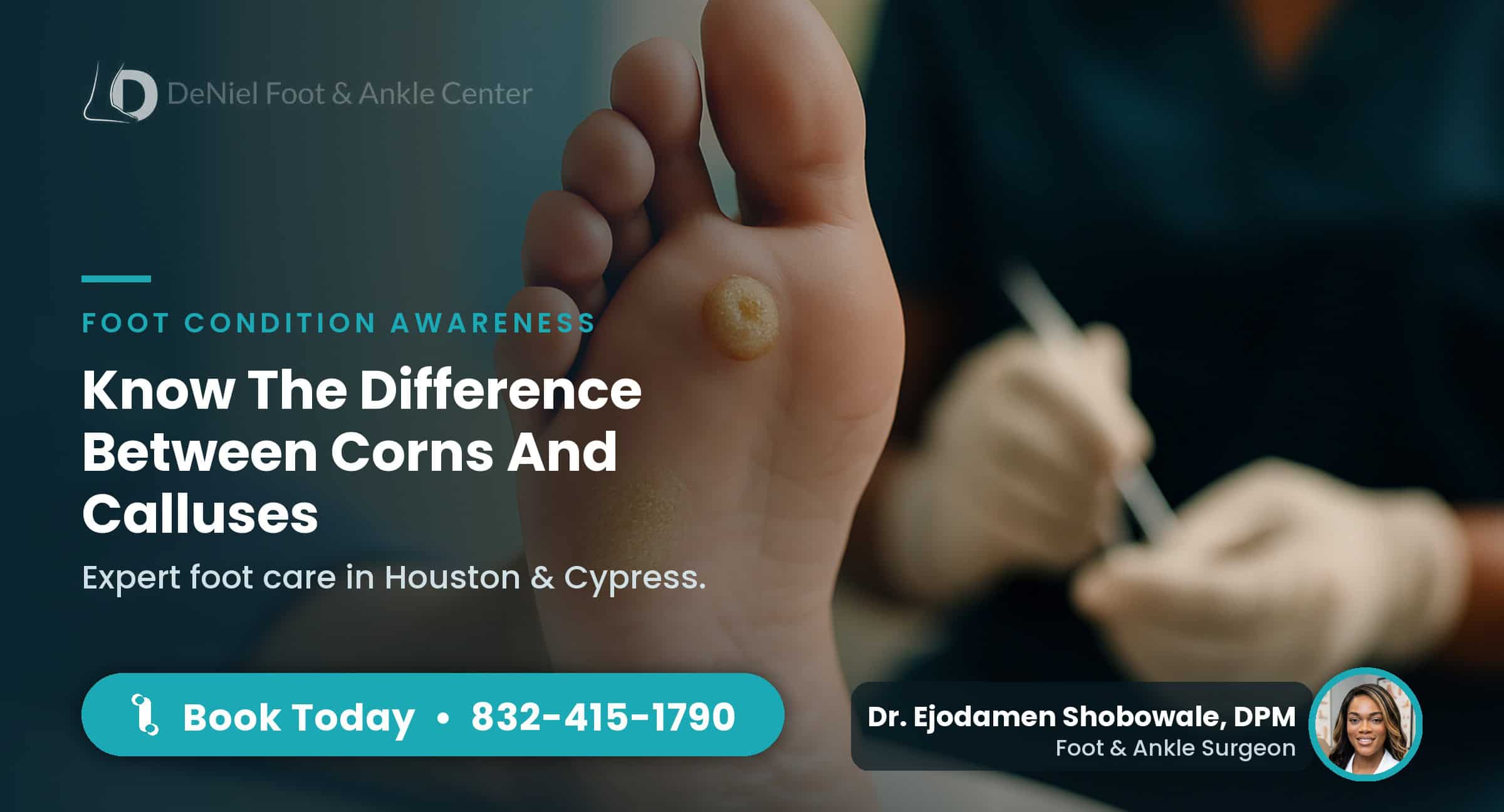 Close-up of foot showing corn and callus differences.
