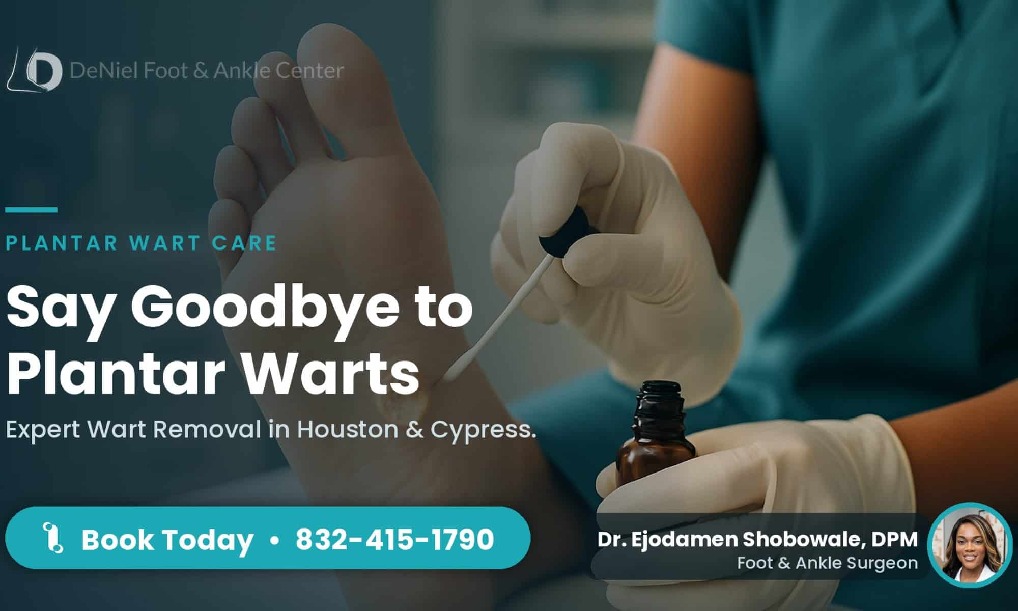 Plantar wart removal treatment in Houston.