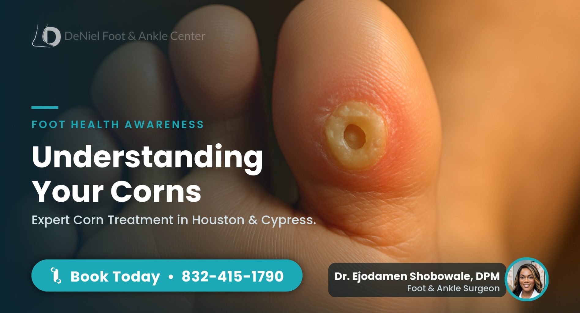 Close-up of a corn on the side of a toe, a common foot condition treated in Houston.