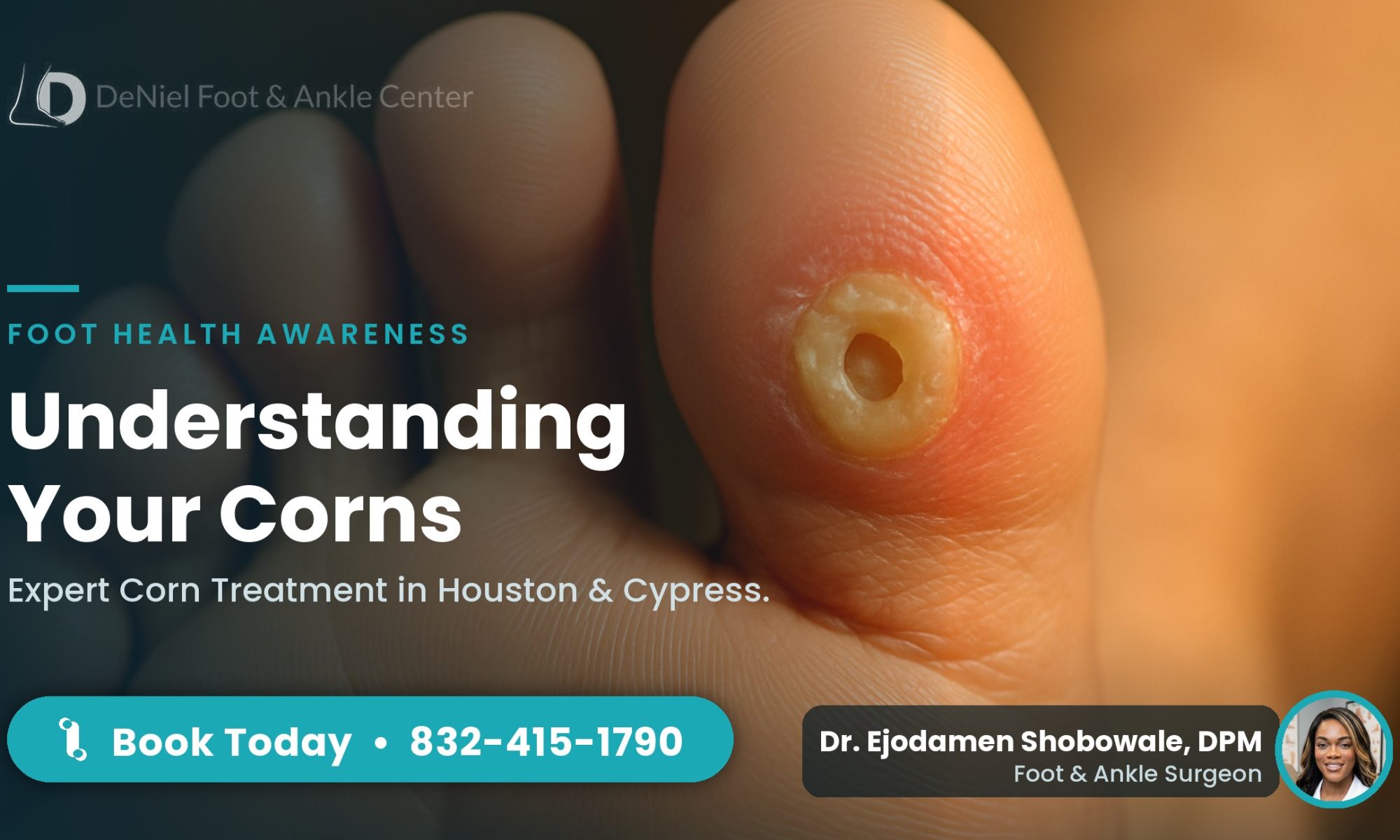 Close-up of a corn on the side of a toe, a common foot condition treated in Houston.